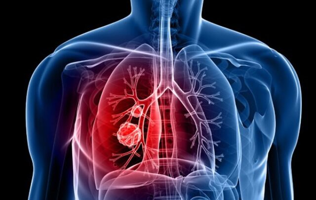 Pneumonia: o que precisamos saber?